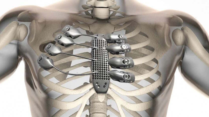 Cancer patient gets world’s first 3D printed ribcage and sternum implant.